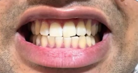 Scaling and polishing result at Neodent Dental Hospital